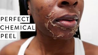 I TRIED A CHEMICAL PEEL  Full Process Before and After Dark Marks amp Acne Scars [upl. by Boynton]