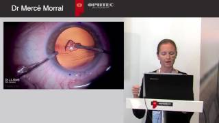 Astigmatism Management in Cataract Surgery with a new Aspheric Toric IOL by Dr Mercé Morral [upl. by Kiryt648]