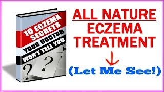 Eczema Treatment  How To Get Rid Of Eczema Naturally [upl. by Oicul]