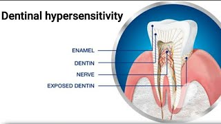 ImpforBds1styrexamDentinal hypersensitivity theories of pain transmission through dentin [upl. by Hescock]