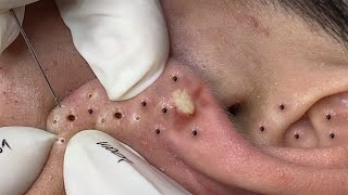 Big Cystic Acne Blackheads Extraction Blackheads amp Milia Whiteheads Removal Pimple Popping  3869 [upl. by Zacarias]