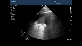 Lung POCUS  Consolidation and Hydropneumothorax [upl. by Annaj]