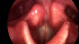 Singing Vocal Folds [upl. by Idelson]