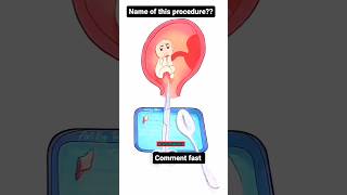 Comment the procedure procedure medical medicalprocedurevideos medicalprocedure medicalstudent [upl. by Eidissac]