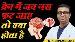 देखें ब्रेन में जब नस फट जाए तो क्या होता है  Brain Hemorrhage  Dr Biplab Das [upl. by Budd]