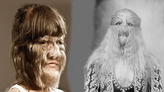 The TERRIFIC History of Hypertrichosis [upl. by Dobrinsky999]