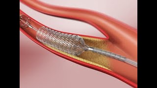 Angioplastia Carotídea [upl. by Andrade197]