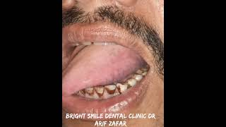 Tongue Fibroma Remove By Laser Bloodless And Painless Surgery Done [upl. by Iives]