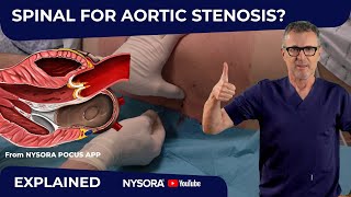 IS SPINAL ANESTHESIA IN AORTIC STENOSIS SAFE [upl. by Emmons]