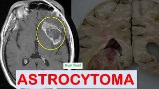 Brain Tumors Part1 Astrocytoma [upl. by Poliard165]