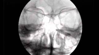 Balloon Sinuplasty Maxillary sinus [upl. by Demaria14]