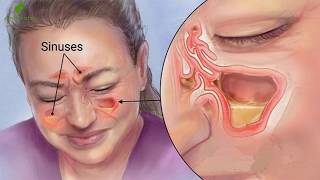 Conoce Como Puedes Eliminar Todo El Moco Y La Flema De Tu Garganta Y Pulmones [upl. by Nuahsad]