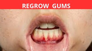 How to regrow receding gums naturally at home Proven Methods for a Healthier Smile [upl. by Noellyn423]