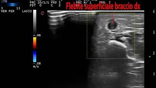 Flebite superficiale avambraccio dx e sin [upl. by Marc]