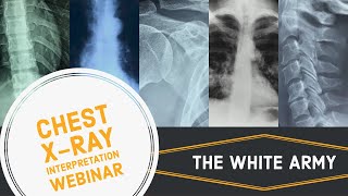 INTERPRETATION OF CHEST XRAY RADIOGRAPH MADE SIMPLIFIED [upl. by Aronow491]