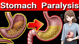 Stomach Paralysis 5 Warning Signs You Shouldnt Ignore Gastroparesis [upl. by Mile]