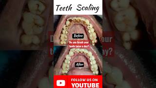 🇳🇵Brush your teeth daily Dental Scaling Tartar Cleaning Deep cleaning Kathmandu Dentist Dr Dentalk [upl. by Roberto]