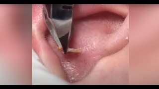 Super satisfying blackhead extraction  Extremely Clogged Pores Extracted [upl. by Leavitt]