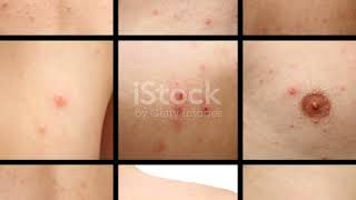 Psoriasis Unveiled Symptoms Causes and Your Path to Relief [upl. by Naivaj]