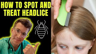 How to spot and treat Head lice nits  Doctor ODonovan explains [upl. by Moscow]