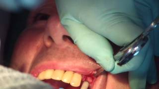 Préparation et pose dun implant dentaire partie 2 de 3 JMM DENTAL IMPLANT [upl. by Kory]