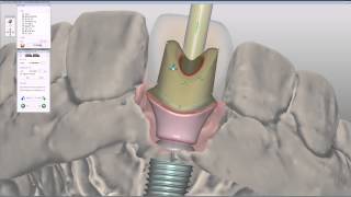 Customized zirconia abutment on titanium base CAD Design [upl. by Eliott]