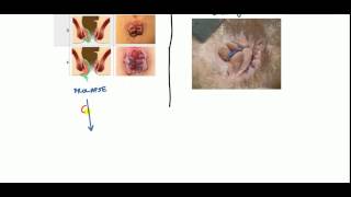 Hemorrhoids Lecture for USMLE [upl. by Janyte]