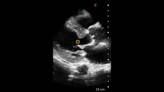 Concentric Left Ventricular Hypertrophy LVH  Ultrasound Image Interpretation [upl. by Jenn471]