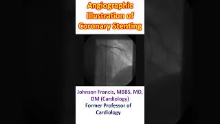 Angiographic Illustration of Coronary Stenting [upl. by Gambell302]