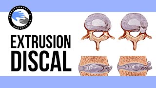 Extrusion discal ¿es realmente tan grave que es y porque se produce [upl. by Proctor5]