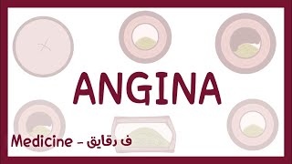 Angina stable angina angina pectoris unstable angina vasospastic prinzmetal angina عربي [upl. by Aimit]