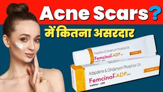 Adapalene Gel On Face  Femcinol ADP  Clindamycin Phosphate Gel  Acne Scars Treatment [upl. by Karia486]