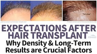 Hair Transplant Expectations Limitations LongTerm Results and an Alternative for Thinning Hair [upl. by Dareg]