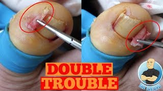 DOUBLE INGROWN TOENAIL REMOVAL FOREVERToe Nail Surgery by The Toe Bro [upl. by Sinnek]