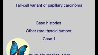 Tall cell variant of papillary carcinoma Other rare tumors  case 1 [upl. by Noramac]