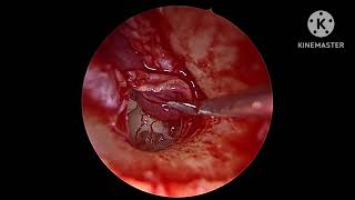 Endoscopic Excision of Fisch type A Right Glomus tympanicum Dr Babu AR JSSAHER Mysuru India [upl. by Netnilc]