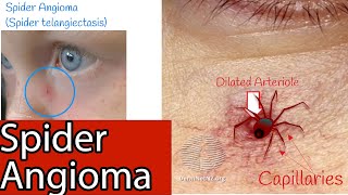 Spider Angioma  Capillaries on the face Spider spider telangiectasia Causes and Treatment [upl. by Cr]