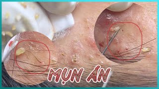 Big Cystic Acne Blackheads Extraction Blackheads amp Milia Whiteheads Removal Pimple Popping [upl. by Enelec]