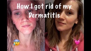 How I Cured My Perioral Dermatitis [upl. by Akimed]