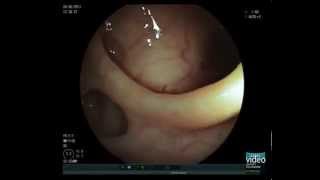 Colonic Diverticulosis [upl. by Bradway862]