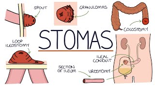 Understanding Stomas Colostomy Ileostomy Urostomy and Gastrostomy [upl. by Etnaid228]