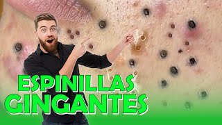 GRANOS y ESPINILLAS GIGANTES Videos Satisfactorios Part 6 [upl. by Celle592]