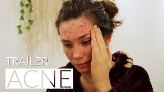 Normalising Acne Documentary  Trailer [upl. by Hodess]