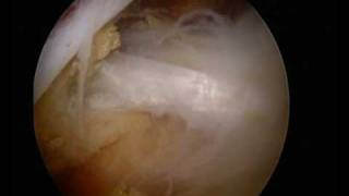 UK Surgeon  wwwshouldersurgeryorguk  Arthroscopic Suprascapular nerve decompression [upl. by Sampson538]