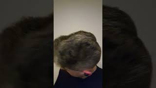 DENSITY from hair transplant and antihair loss medication [upl. by Lotsirhc974]