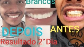 Clareamento DentárioProfissional whiteness Perfect 22 Dentes Brancos veja o Resultado shorts [upl. by Arianne515]