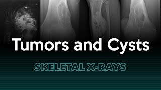 Tumors and Cysts Skeletal Xrays [upl. by Oiramal586]