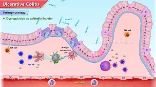 Ulcerative Colitis Animation  Etiology Clinical features Pathophysiology Diagnosis Treatment [upl. by Ahsilra]