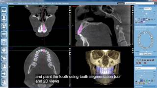 Planmeca Romexis 3D Ortho Studio – Orthodontic treatment planning with roots and [upl. by Refinaj]