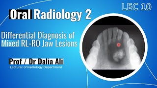 Oral Radiology 2  Lec 10  Differential Diagnosis of Mixed RL  RO Jaw Lesions [upl. by Krenn619]